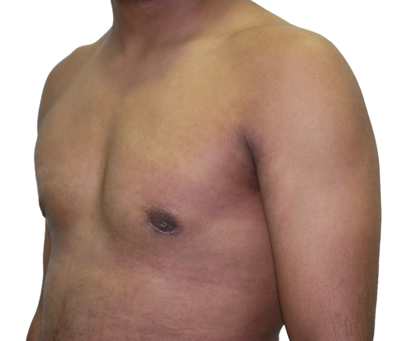 After Surgery Result