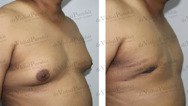 Gynecomastia Surgery Result - Grade 3