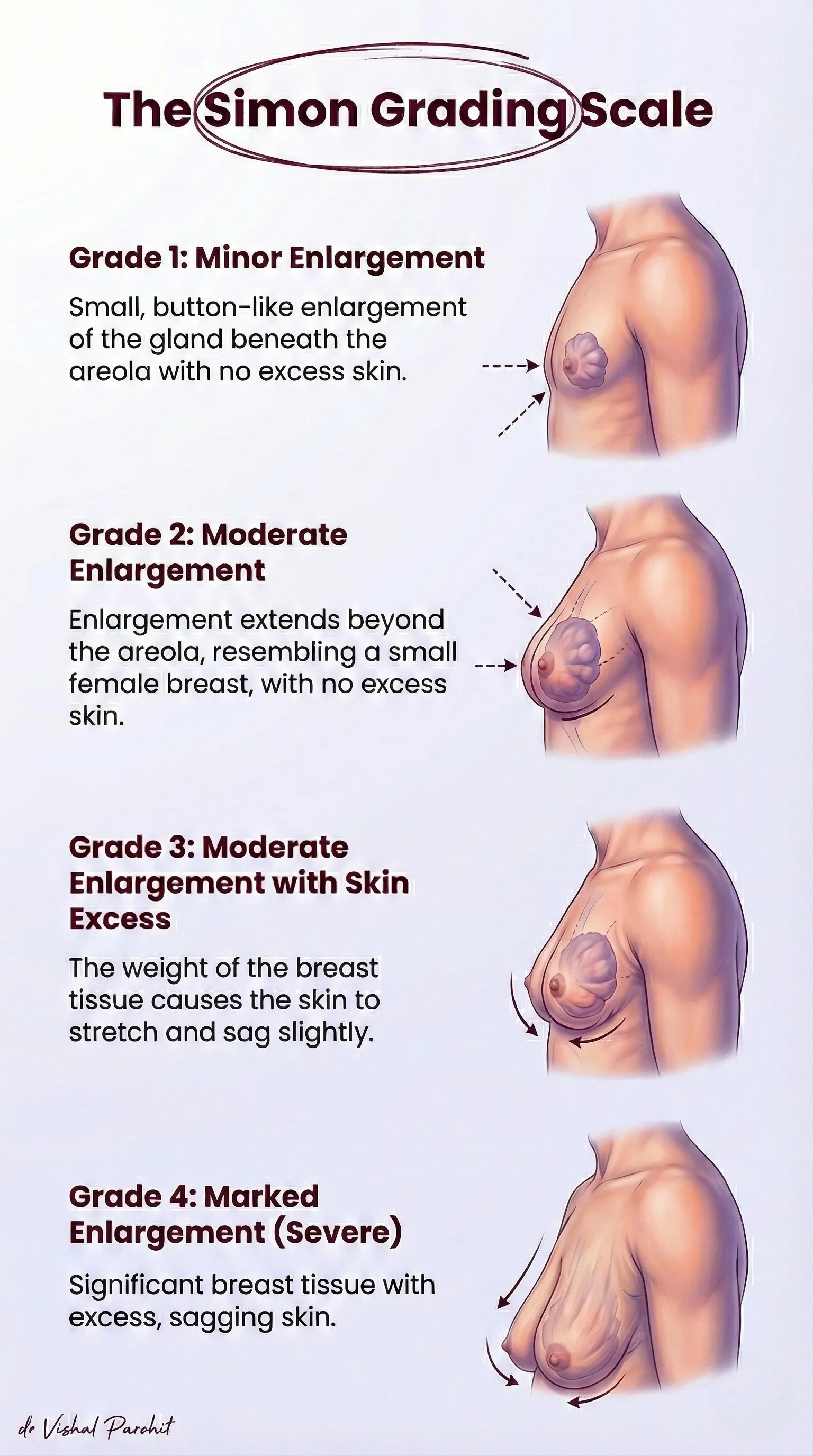 Gynecomastia Grades